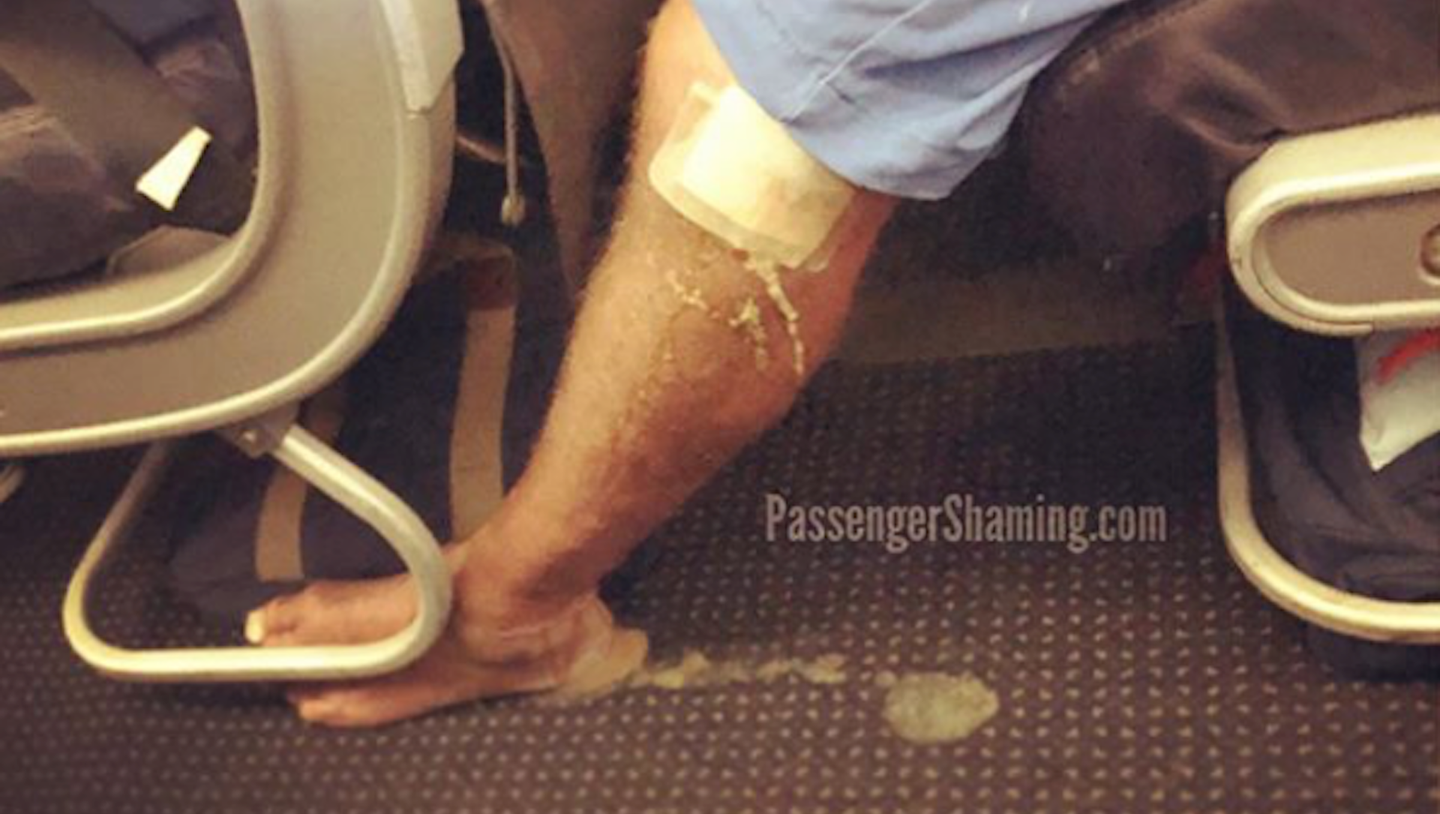 Airplane Passenger With Horrific, Pus-Oozing Leg Wound Is What Travel Nightmares Are Made Of